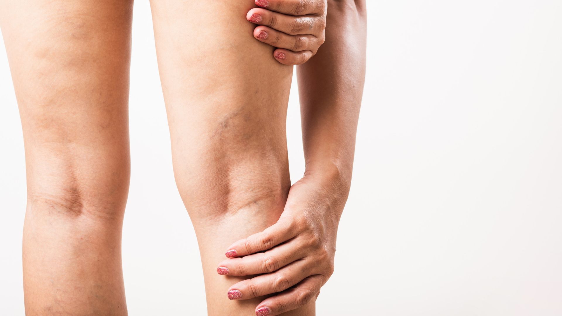 Varicose veins during pregnancy - what you need to know