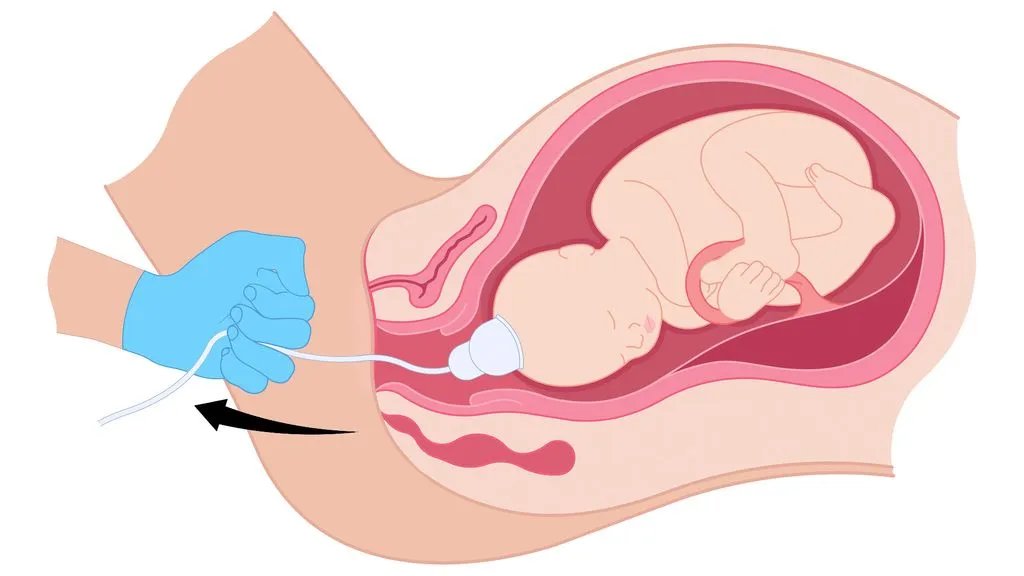 Sugklocka – en hjälp under förlossningen